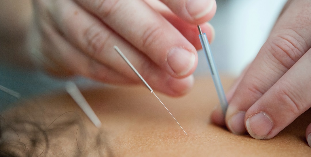 This is a closeup of an acupuncturist placing a needle into someone's back; this represents acupuncture for autistic children
